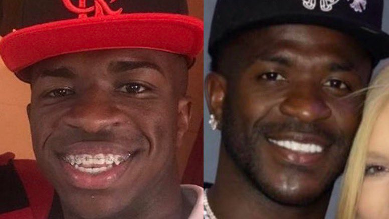 antes e depois de Vini Jr. Harmonização facial